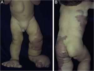 (A) Vascular malformations in the left lower limb. Leg and foot deformities and abdominal tumor. (B) Extensive vascular malformations in the thorax, hip and thighs with mosaic distribution.