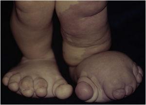 Details of foot deformities with asymmetric gigantism and syndactyly.