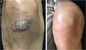 Case 1. (A) Asymptomatic verrucous plaque, measuring approximately 5.0×3.0cm, with well-defined borders, and small areas intermingled with blackened dots and satellite lesions, located on the extensor surface of the right knee. (B) Three years after surgical excision with safety margins, both superficial and deep.
