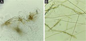 Case 1. (A) Septate, brownish hyphae (“Borelli spiders”). Direct microscopy, KOH 20% + DMSO, ×40. (B) Colony micromorphology showing brownish, septate hyphae, from which conidiophores with elongated conidia at their extremities arise, giving the appearance of a gnarled staff. Rhinocladiella spp., lactophenol, ×40.