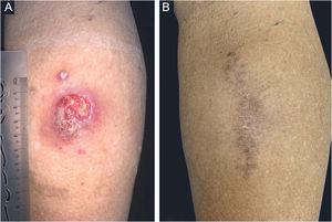 Case 2. (A) An infiltrated, well-delimited plaque, with ulceration and purulent background, measuring approximately 5.0cm, on the posterior right calf and a nearby verrucous lesion, measuring approximately 0.5cm; (B) Eight months after follow-up.