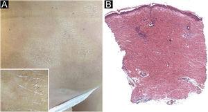 (A) Whitish and sclerotic plaques localized in abdomen and groin. Insert left: dermoscopy showed prominent whitish fibrotic beams and loss of hair in the involved area. (B) Histology showed a thickening and hyalinization of connective tissue of deep dermis and subcutaneous fat, with atrophy of adnexal structures, increased fibroblasts and dense collagens through the deep dermis (Hematoxylin & eosin, 50×).