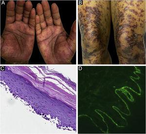 Case 2. (A) Lichenoid lesions with scattered vesicles on hands and (B) thighs. (C) An interface process histologically. (D) Intense linear deposition of C3 along BMZ.