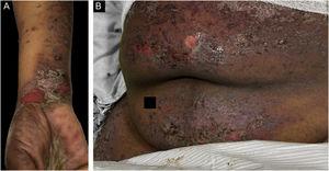 Case 3. (A) Scaly lichenoid and bullous lesions on wrists (B) abdomen.
