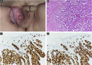 (A) Clinical findings of primary EMPD. A rash and elevated lesions are found in the right scrotum. (B) Primary EMPD: Tumors that grow individually or alveolarly are found in the basal layer of the epidermis. There is a part where infiltration into the dermis layer is observed. Tumor cells have pale-colored vesicles, and the nuclei are irregularly shaped and unevenly distributed. (Hematoxylin & eosin, ×200). (C) Positive CK7 immunostaining (immunohistochemical staining for CK7 × 200). (D) Positive CAM2.5 immunostaining (Immunohistochemical staining for CAM2.5, ×200).