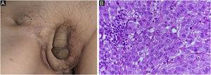 Clinical findings. A subcutaneous mass in the right inguinal area is observed. (A) Atypical cells with a pale cytoplasm proliferated rapidly, and the findings are similar to those of previous invasive Paget’s disease (Hematoxylin & eosin, ×400).