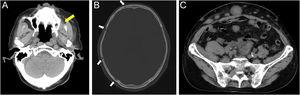 Computed tomography findings. (A) Soft tissue tumor in the left maxillary sinus (yellow arrow). (B) Osteolytic changes in the skull (white arrows). (C) Multiple abdominal subcutaneous and intraperitoneal metastases.