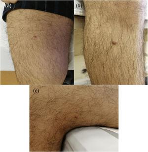(A–C) Lesions located on lower extremities.