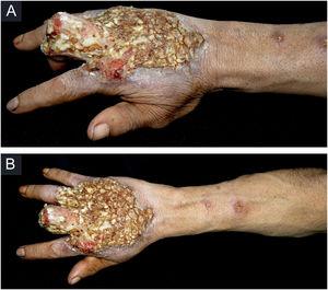 (A) Ulcer on the dorsum of the right hand covered by yellowish crusts, with clear erythematous borders extending to the phalanges with anatomical deformity of the third finger. (B) Ulcerated nodules following an ascending lymphatic path in the right forearm.