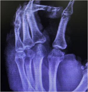 Right-hand x-ray. Presence of bone sequestration, and destruction of the cortex of the distal and middle phalanges of the third finger, suggestive of chronic osteomyelitis.