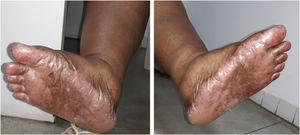 Hyperpigmentation, desquamation and dryness on the soles and inner region of the feet.