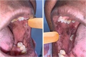 Clinical aspect of hyperpigmented spots on the bilateral buccal mucosa and tongue edges.