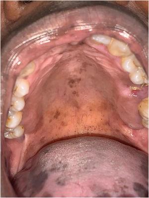 Hyperpigmented spots on the hard palate.