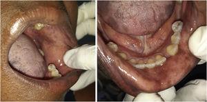 Attenuation of pigmented spots on the oral mucosa, when the medication was interrupted.