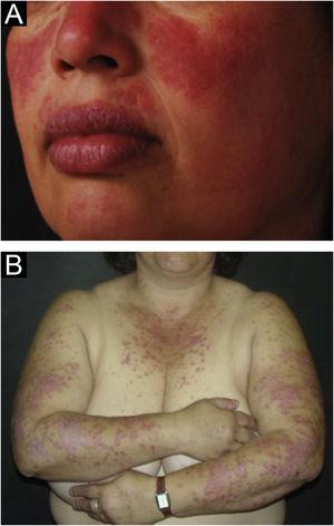 Acute cutaneous lupus erythematosus. (A) Localized form: butterfly rash on the malar regions. (B) Disseminated form: symmetrical papulosquamous eruption, affecting the trunk and upper limbs.