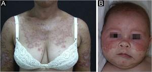 (A) Subacute cutaneous lupus erythematosus: annular, erythematous, papulosquamous plaques, confluent on the chest and upper limbs. (B) Neonatal lupus erythematosus: circular and polycyclic erythematous plaques on the face.