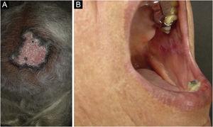 Chronic cutaneous lupus erythematosus. (A) Discoid form located on the scalp, with cicatricial alopecia. (B) Discoid form, affecting the buccal mucosa.