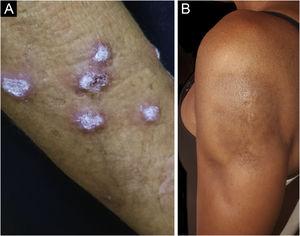 Chronic cutaneous lupus erythematosus. (A) Verrucous variant, located on the upper limb. (B) Lupus panniculitis, affecting the arm and progressing to lipoatrophy.