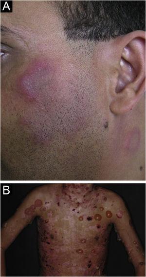 (A) Lupus erythematosus tumidus: arciform and annular erythemato edematous lesions on the face and neck. (B) Bullous lupus erythematosus: bullous, hemorrhagic ulcerocrusted, and hypochromic residual lesions located in the cervical region, trunk, axillae and upper limbs.