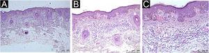 Histopathological analysis showing moderate peritumoral inflammatory infiltrate: Hematoxylin & eosin; (A), ×4 magnification; (B), ×10 magnification; (C), ×20 magnification
