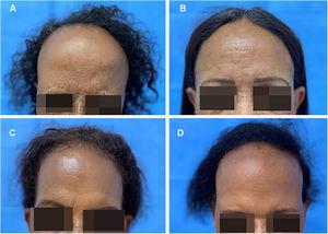 (A‒D) Clinical presentation of the four sisters affected by frontal fibrosing alopecia (FFA)