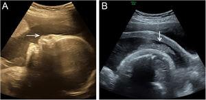 (A) 2-D ultrasound: The fetal face shows a flat curve and nasal hypoplasia (arrow) at the median sagittal section. (B) 2-D ultrasound: Abnormal skin flocculent echo (arrow)