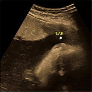 2-D ultrasound: microtia (arrow)