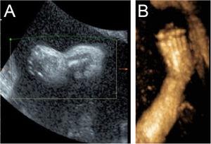 (A) 2-D ultrasound: the image of the right feet of the fetus. (B) 3-D ultrasound: pedal oedema and clubfeet