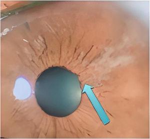 Patient’s ophthalmoscopy, showing iris retraction and areas of fibrosis