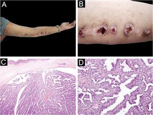 (A, B) Several normochromic papules, some with a warty surface, with a diameter of about 1 ∼ 2.5cm on the left upper limb, arranged in a linear pattern. (C) The tumor is located in the superficial dermis without connection to the overlying epidermis, composed of cystadenoma-like structures and folded papillary structures. (Hematoxylin & eosin, ×40). (D) The cystic spaces and papillary structures are lined with single columnar epithelium and surrounded by a layer of small cuboidal myoepithelial cells, forming a special double-layer structure. (Hematoxylin & eosin, ×400)