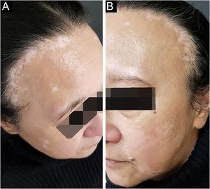 Clinical findings of patient 1. (A) Hair rarefaction on the frontal region of the scalp, coexisting with achromic macules of vitiligo. (B) Eyebrows rarefaction on a growing vitiligo macule
