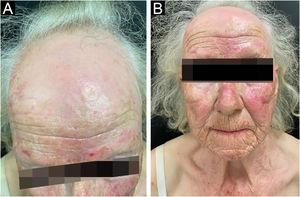 Clinical findings of patient 2. (A-B) Complete depigmentation of the skin, accompanied by frontal alopecia with an atrophic aspect of the scalp, pseudo-fringe sign and almost complete loss of hairs in both her eyebrows