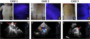 (A‒I) Clinical images at physical examination, under Wood´s lamp and sonographic imaging of cardiac rhabdomyomas of each case