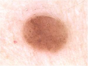Dermoscopic image: presence of multiple bluish-gray dots in the middle of the brownish amorphous area and discrete thin vessels