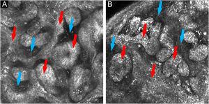(A and B) In vivo confocal microscopy: islets and cords of tumor cells with a palisade periphery (red arrows), forming anastomoses, surrounded by fibrous stroma (blue arrows)