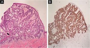 (A) Histopathology of the lesion showing cords of tumor cells with a palisaded periphery (Hematoxylin & eosin, ×40). (B) Immunohistochemistry demonstrating the expression of BER-EP4 in the cords of tumor cells (×40)