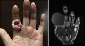 Clinical images of skin lesion, July 2020. (A) Red-purple painless nodule in the left index finger. (B) A representative MRI image