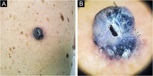 Case 1. (A) Intensely pigmented exophytic tumor with ulcerated center in the lumbar region. (B) Dermatoscopy shows a homogeneous blue-violet pattern, blue-grey veil, and central ulceration
