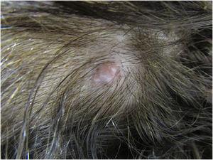 Clinical picture of the lesion, located on the scalp. A bluish spot is visible with the naked eye