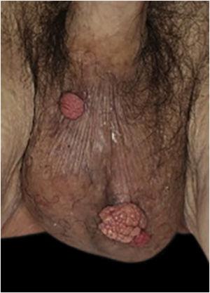 Well-circumscribed, exophytic and pedunculated nodules on the scrotum