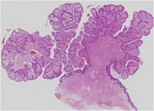 Histopathological findings showed upwardly protruding tumors with acanthosis and papillomatosis