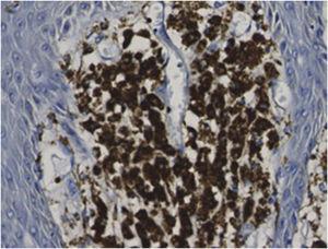 Foamy macrophages in the papillary dermis showing CD68 positivity