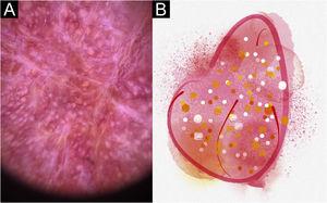 Sporotrichosis infiltrated plaque lesion on the face of patient (n = 21) at cure. (A) Dermoscopy. (B) Illustration of the dermoscopic pattern “strawberry”. The “strawberry pattern” is composed of general erythema with follicular plugs, white dots, and linear vessels