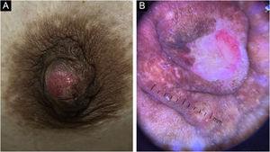 (A) A firm nodule with a central erosion on the right nipple. (B) Dermoscopy showed pink-white clouds and red structureless areas