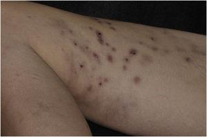 Erythematous-violaceous ulcerated macules and nodules, some covered by hematic crusts, located on the medial surface of the right thigh