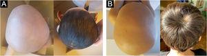 Clinical response to mesalazine in patients with universal alopecia areata. (A) Patient aged three years and six months, before and after 12 months of treatment. (B) Seven-year-old patient, before and after 12 months of treatment