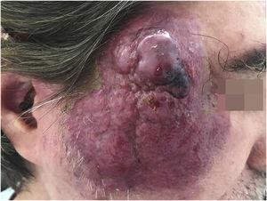 A case of Merkel cell carcinoma in an immunosuppressed patient with acquired immunodeficiency syndrome.