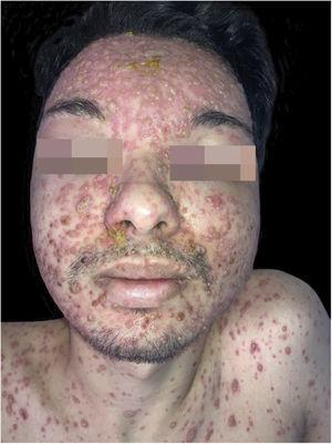 Varicella in a renal transplant patient: multiple vesico-bullous lesions, mostly monomorphic, on an erythematous base, disseminated over the face, some covered by meliceric crusts