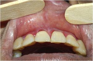 Synechiae in the gingival sulcus, associated with erosions, due to lichen planus of long evolution.