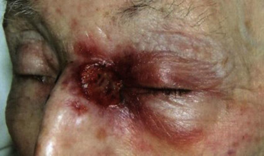 Imiquimod comprar españa